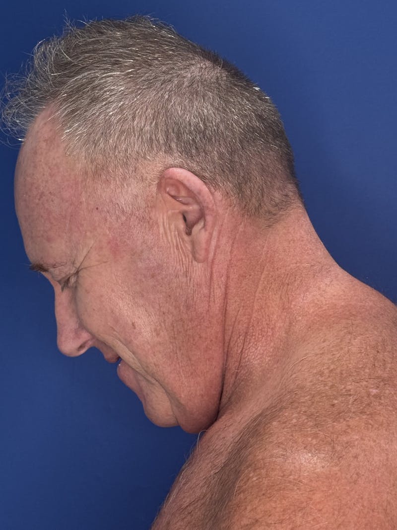 Face Lift Before & After Gallery - Patient 167892 - Image 9