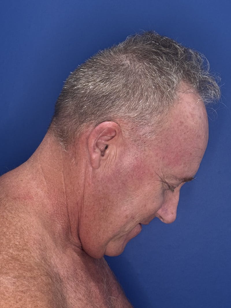 Face Lift Before & After Gallery - Patient 167892 - Image 7