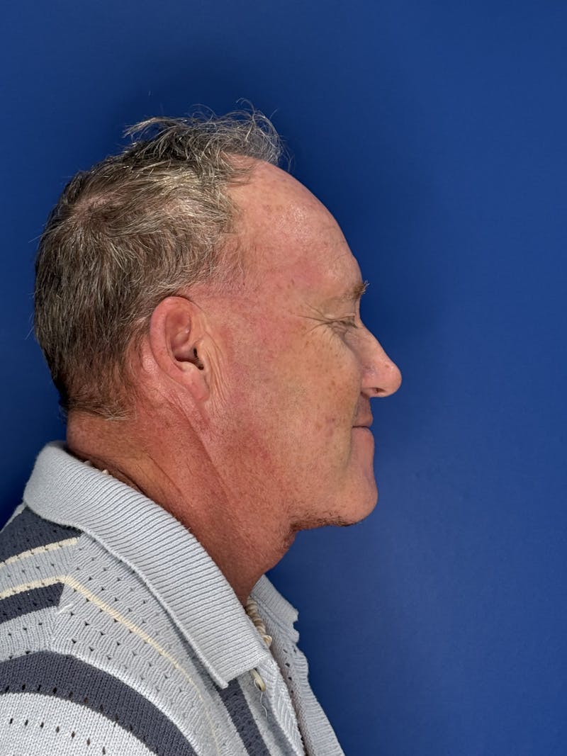 Face Lift Before & After Gallery - Patient 167892 - Image 6