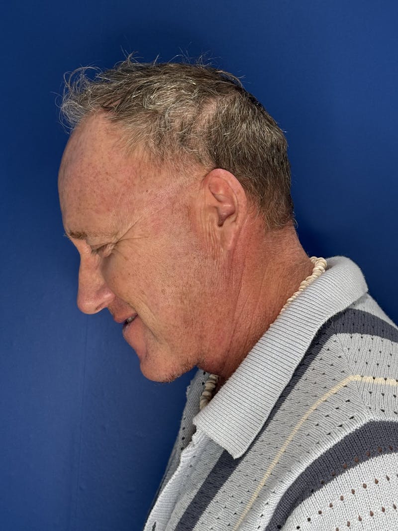 Face Lift Before & After Gallery - Patient 167892 - Image 10