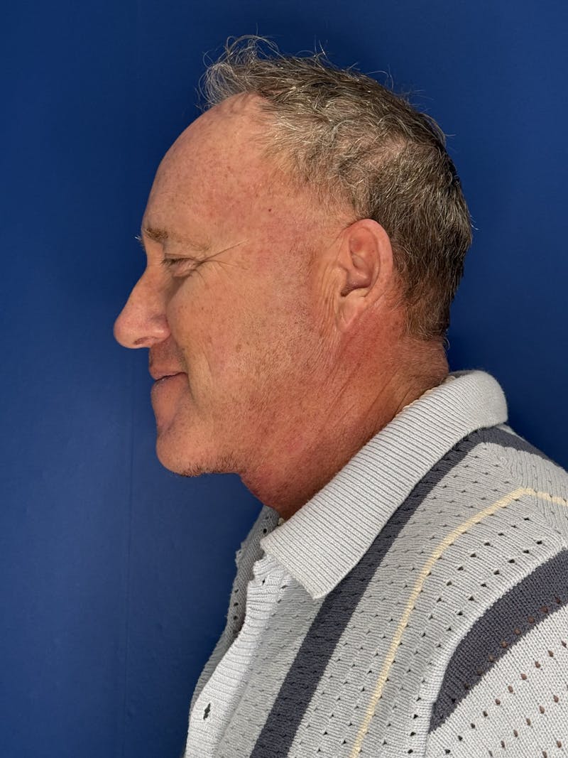 Face Lift Before & After Gallery - Patient 167892 - Image 12