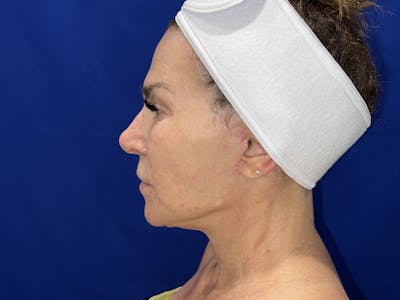 Face Lift Before & After Gallery - Patient 242829 - Image 2