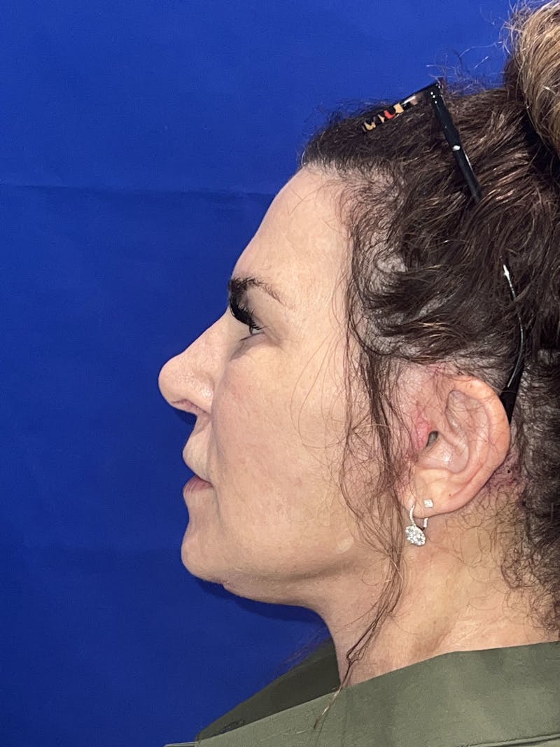 Face Lift Before & After Gallery - Patient 242829 - Image 1