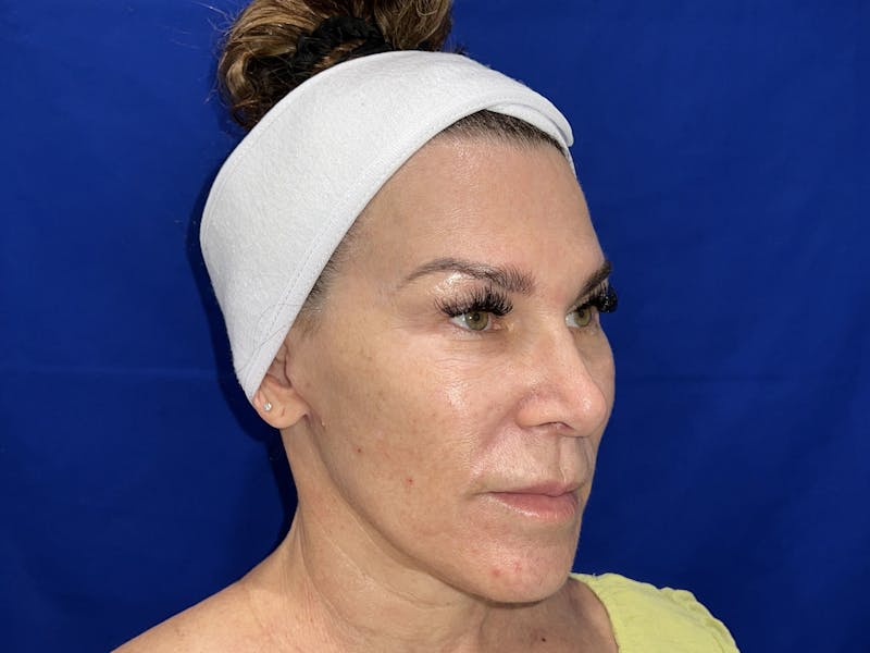 Face Lift Before & After Gallery - Patient 242829 - Image 6