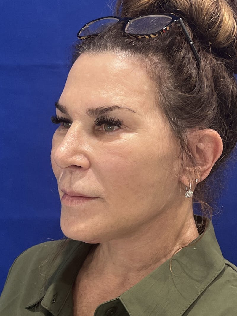 Face Lift Before & After Gallery - Patient 242829 - Image 7