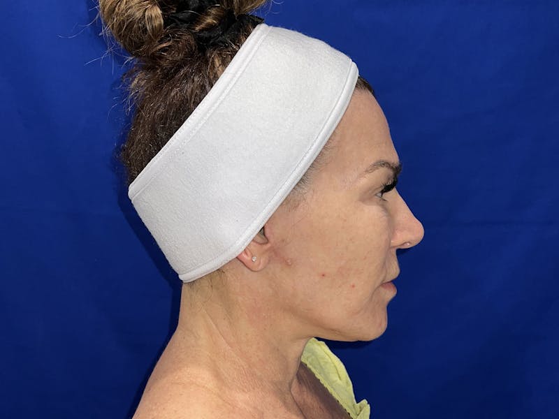 Face Lift Before & After Gallery - Patient 242829 - Image 4