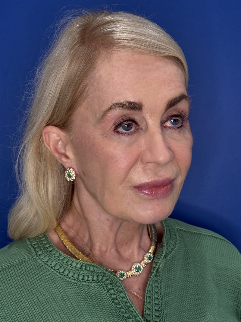 Face Lift Before & After Gallery - Patient 147123 - Image 5