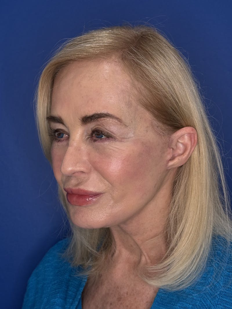 Face Lift Before & After Gallery - Patient 147123 - Image 2