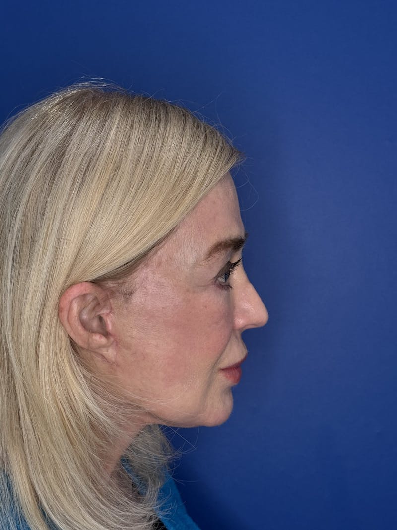 Face Lift Before & After Gallery - Patient 147123 - Image 8