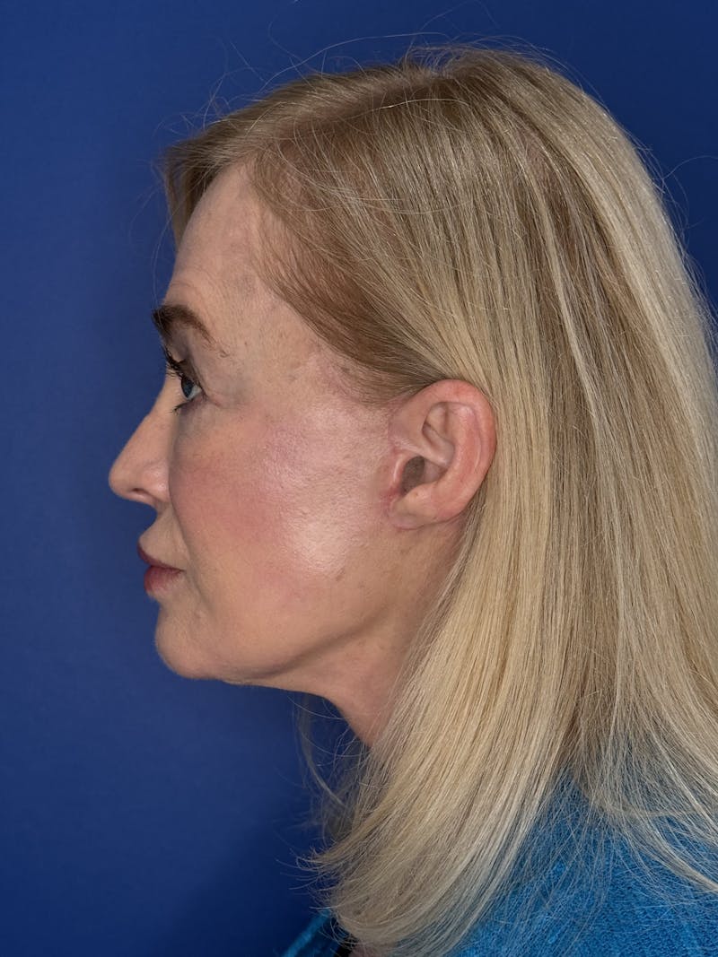 Face Lift Before & After Gallery - Patient 147123 - Image 10