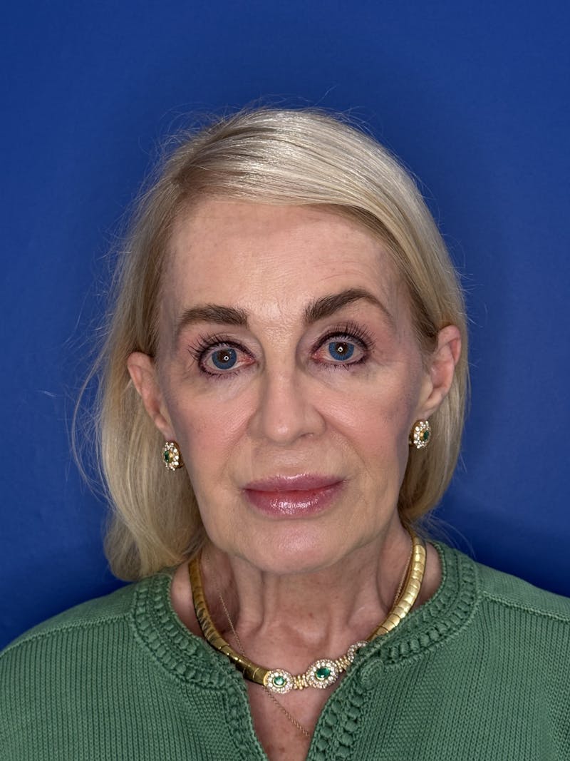 Face Lift Before & After Gallery - Patient 147123 - Image 3