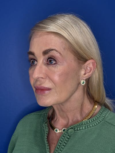 Face Lift Before & After Gallery - Patient 147123 - Image 1