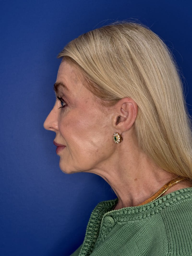 Face Lift Before & After Gallery - Patient 147123 - Image 9