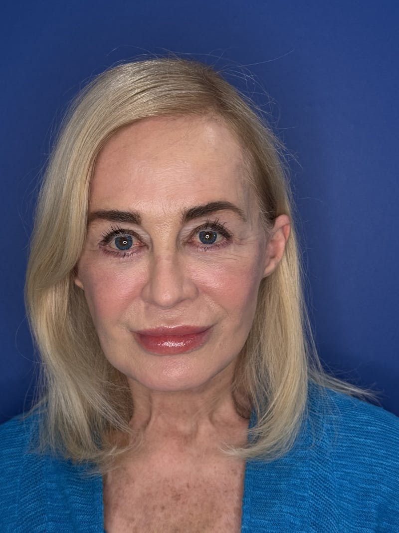 Face Lift Before & After Gallery - Patient 147123 - Image 4