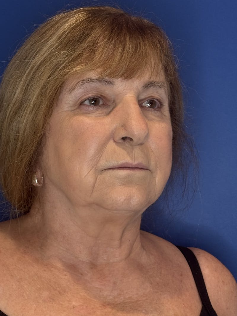 Face Lift Before & After Gallery - Patient 340457 - Image 7