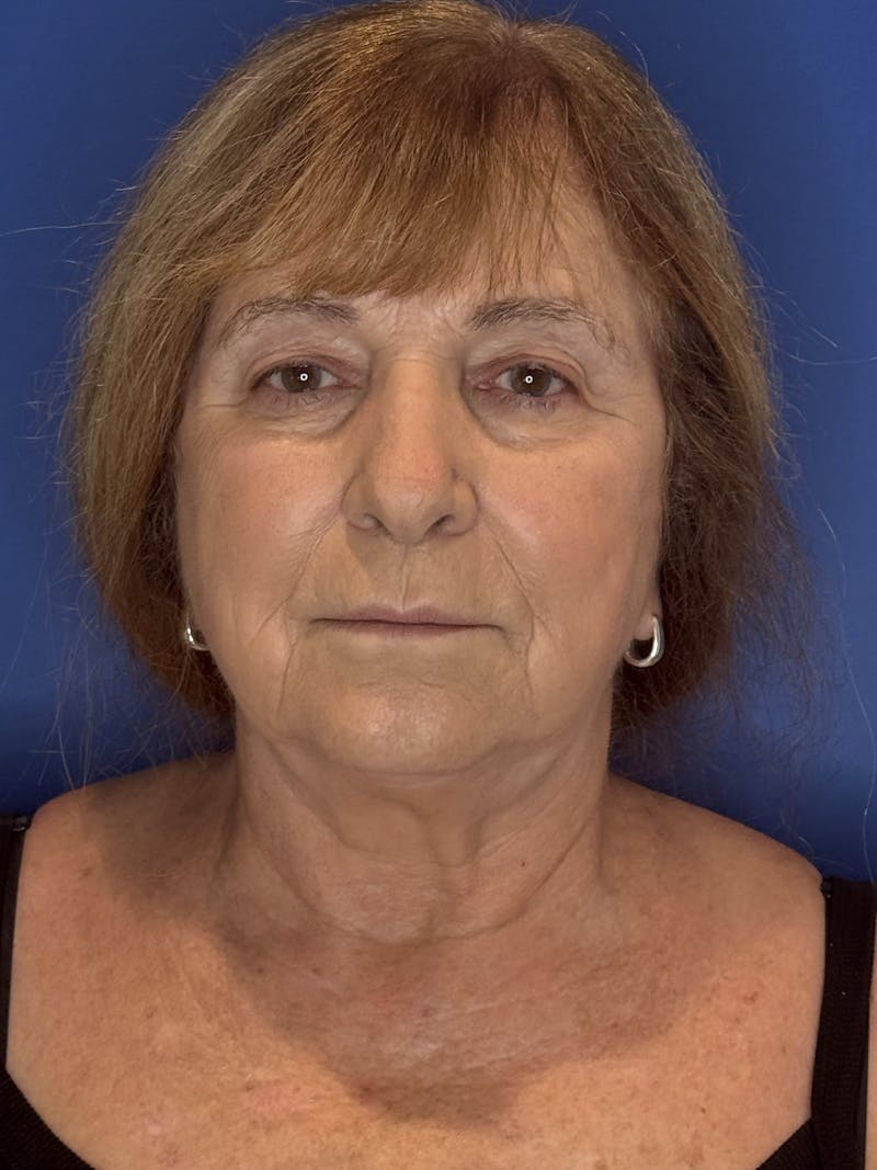 Face Lift Before & After Gallery - Patient 340457 - Image 9