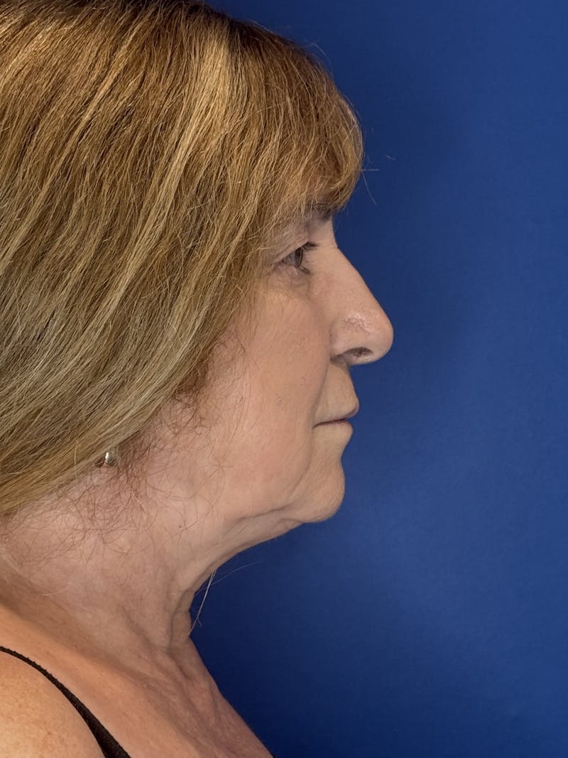 Face Lift Before & After Gallery - Patient 340457 - Image 11