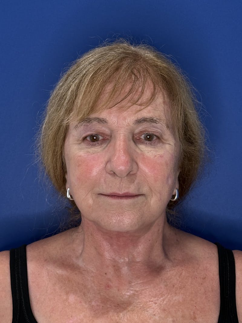 Face Lift Before & After Gallery - Patient 340457 - Image 10