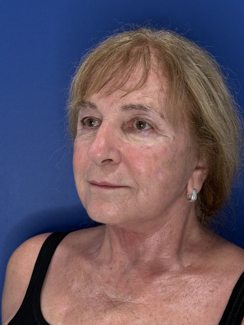 Face Lift Before & After Gallery - Patient 340457 - Image 2