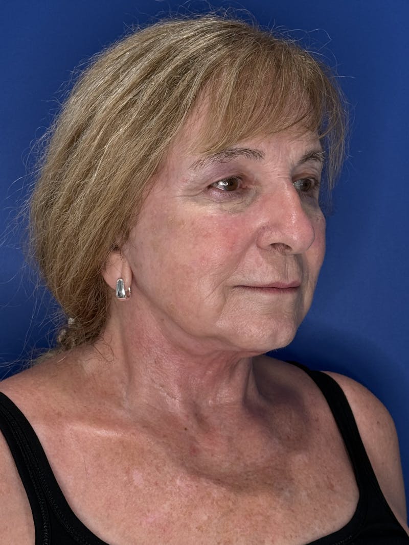 Face Lift Before & After Gallery - Patient 340457 - Image 8