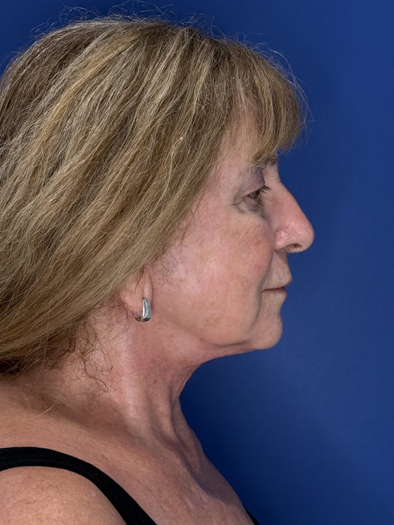 Face Lift Before & After Gallery - Patient 340457 - Image 12