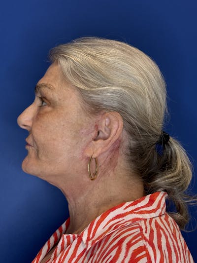 Face Lift Before & After Gallery - Patient 246199 - Image 2