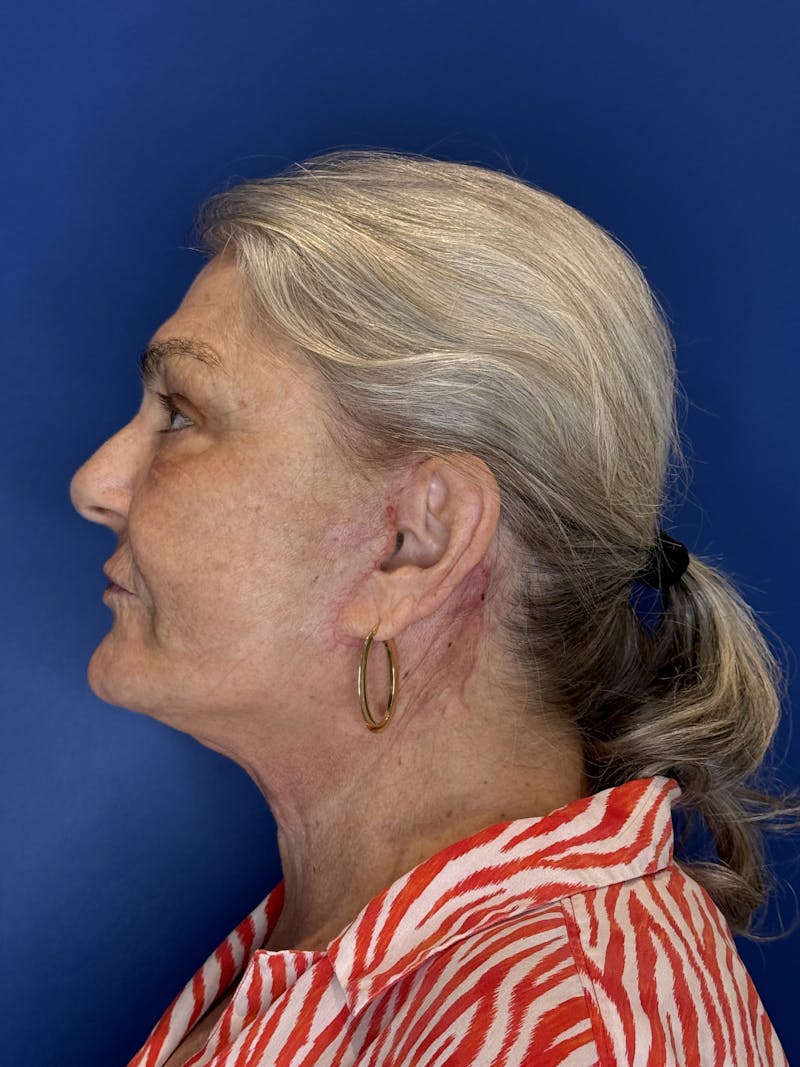 Face Lift Before & After Gallery - Patient 246199 - Image 2