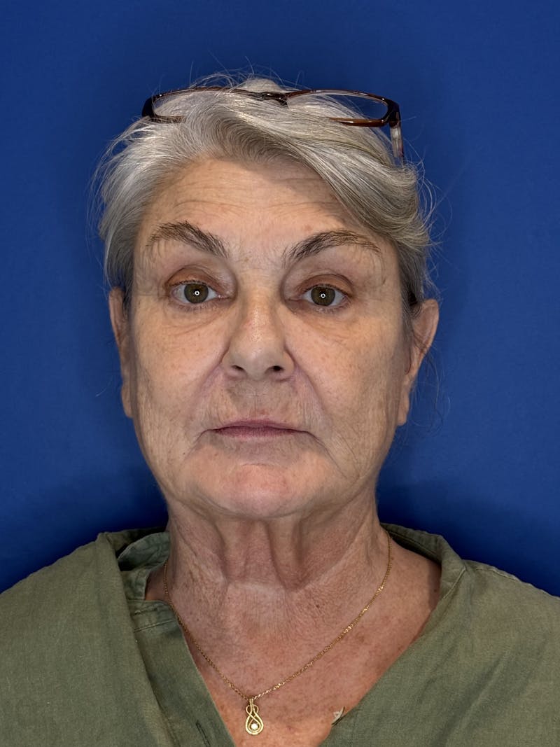 Face Lift Before & After Gallery - Patient 246199 - Image 7
