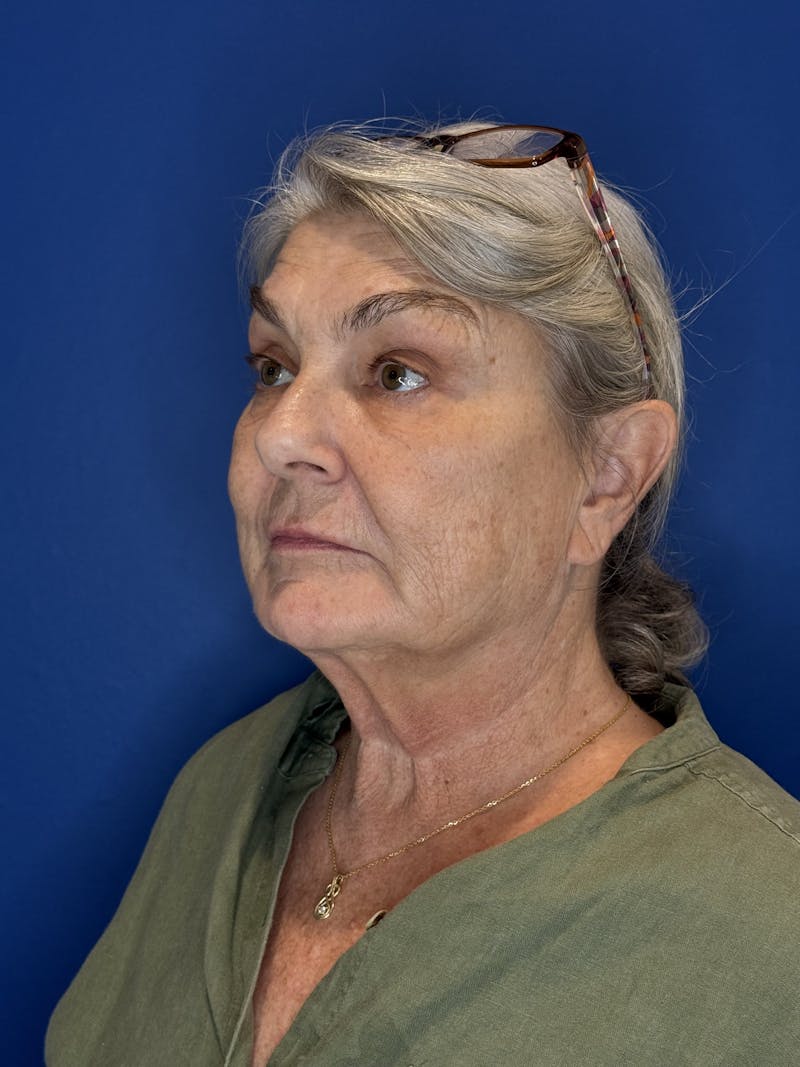 Face Lift Before & After Gallery - Patient 246199 - Image 5