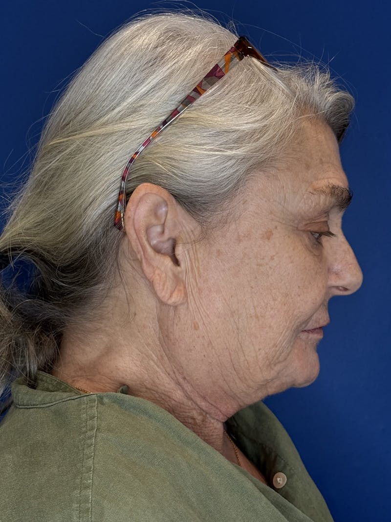 Face Lift Before & After Gallery - Patient 246199 - Image 13