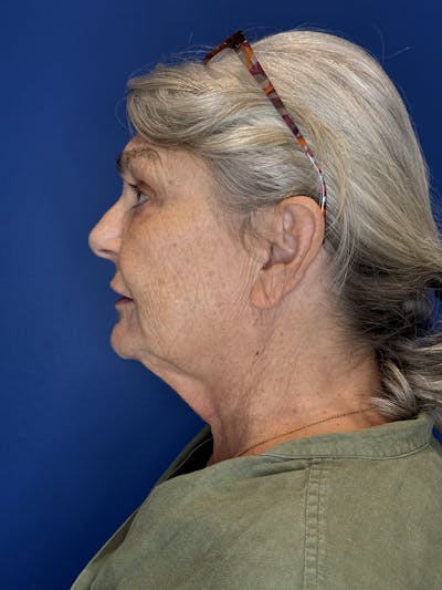 Face Lift Before & After Gallery - Patient 246199 - Image 1