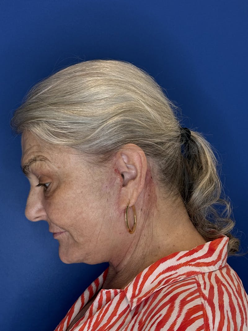Face Lift Before & After Gallery - Patient 246199 - Image 10
