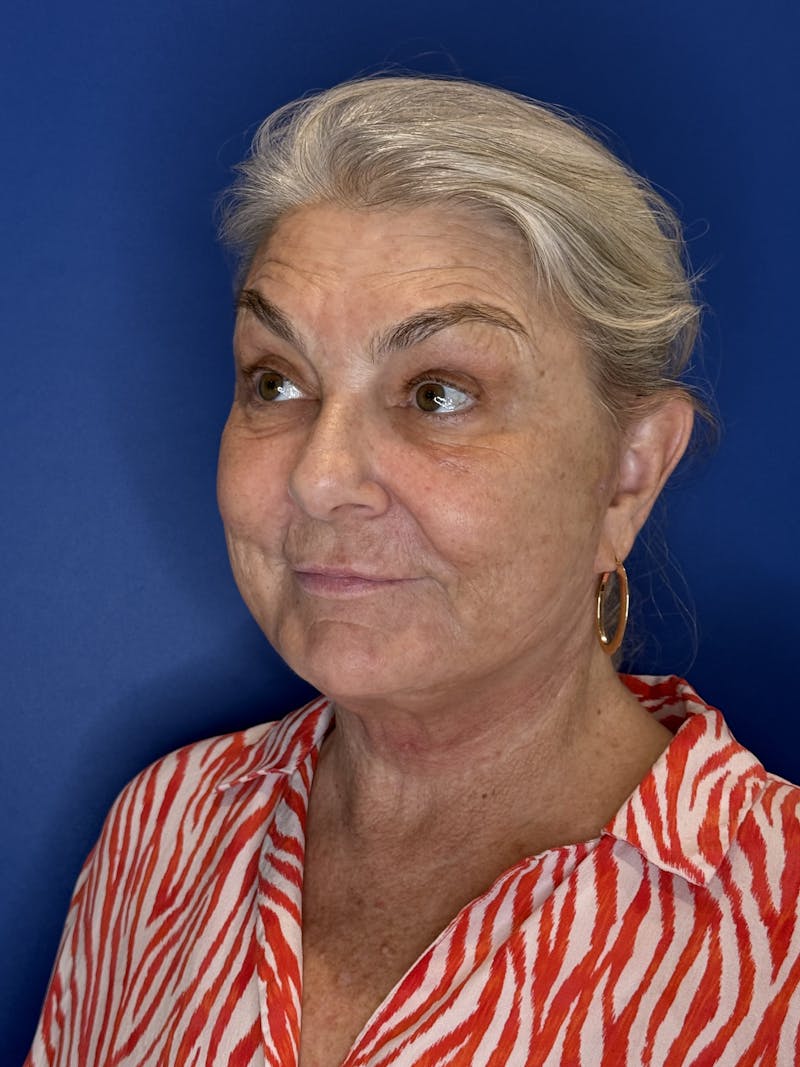 Face Lift Before & After Gallery - Patient 246199 - Image 6
