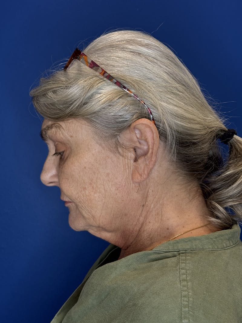 Face Lift Before & After Gallery - Patient 246199 - Image 9