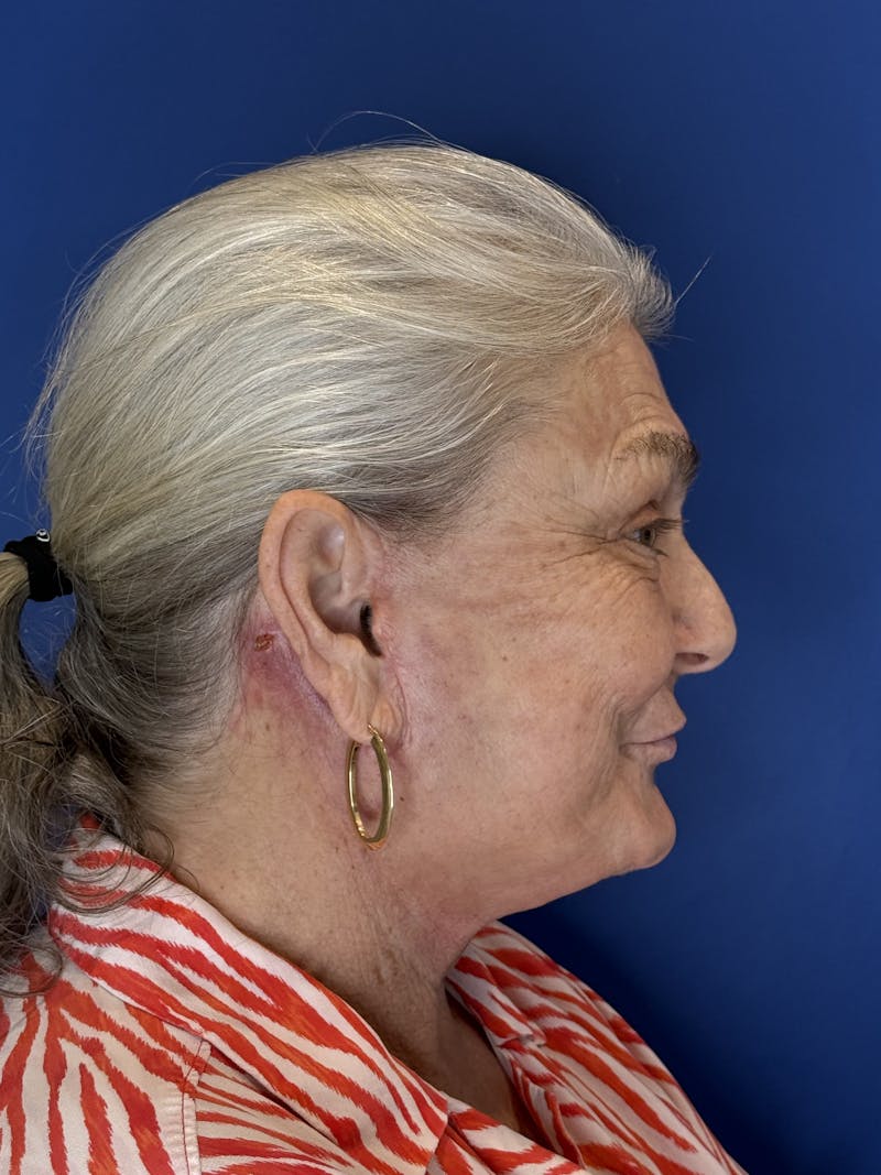Face Lift Before & After Gallery - Patient 246199 - Image 12
