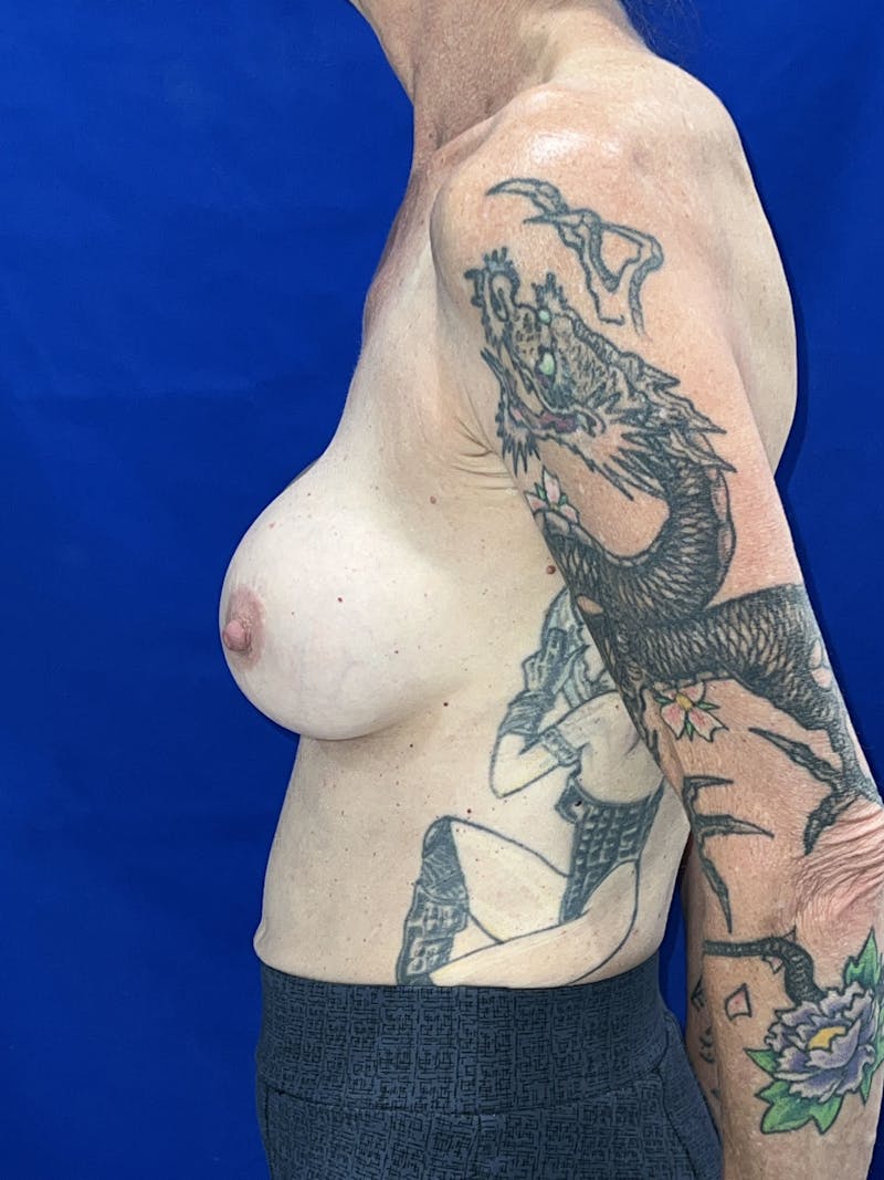 Implant Remove & Replace Before & After Gallery - Patient 205579 - Image 9