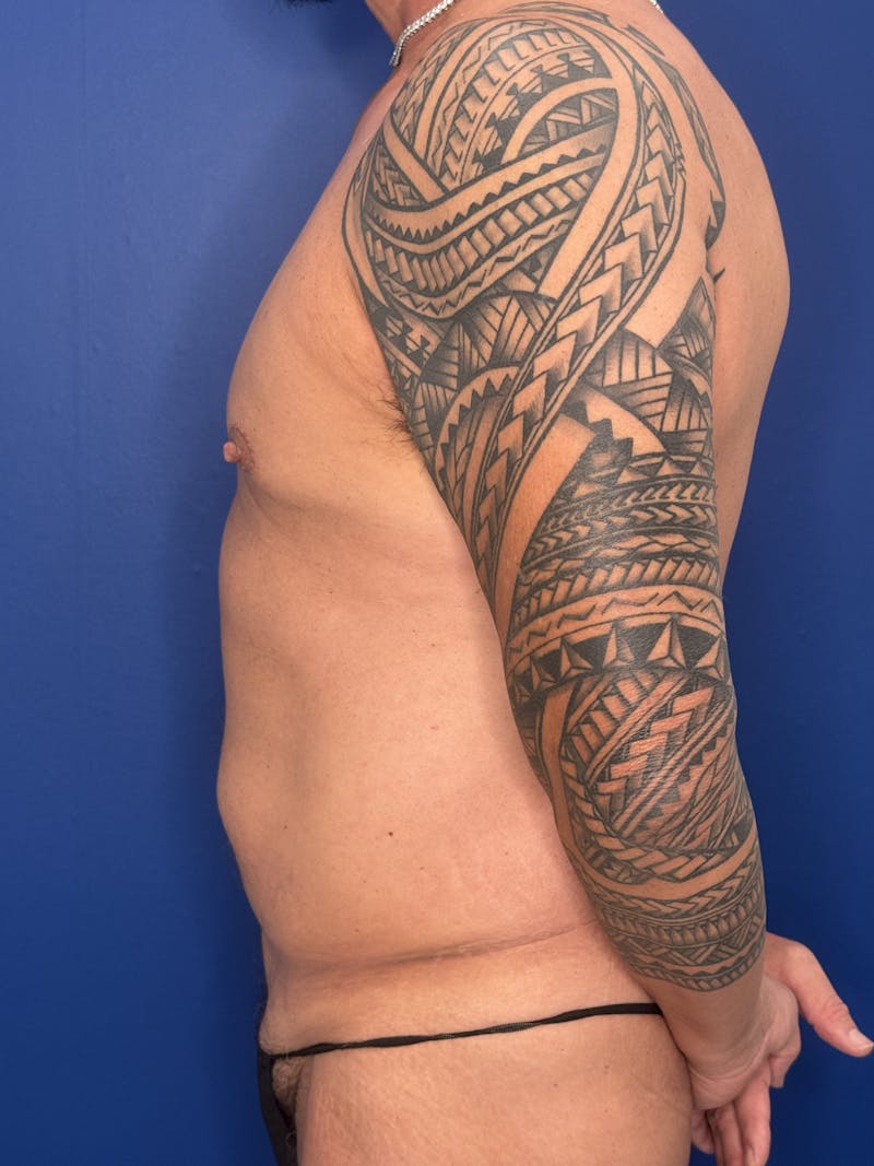 Liposuction Before & After Gallery - Patient 241958 - Image 10