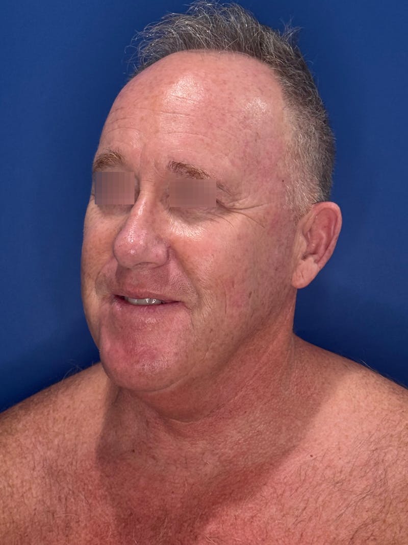 Face Lift Before & After Gallery - Patient 167892 - Image 3