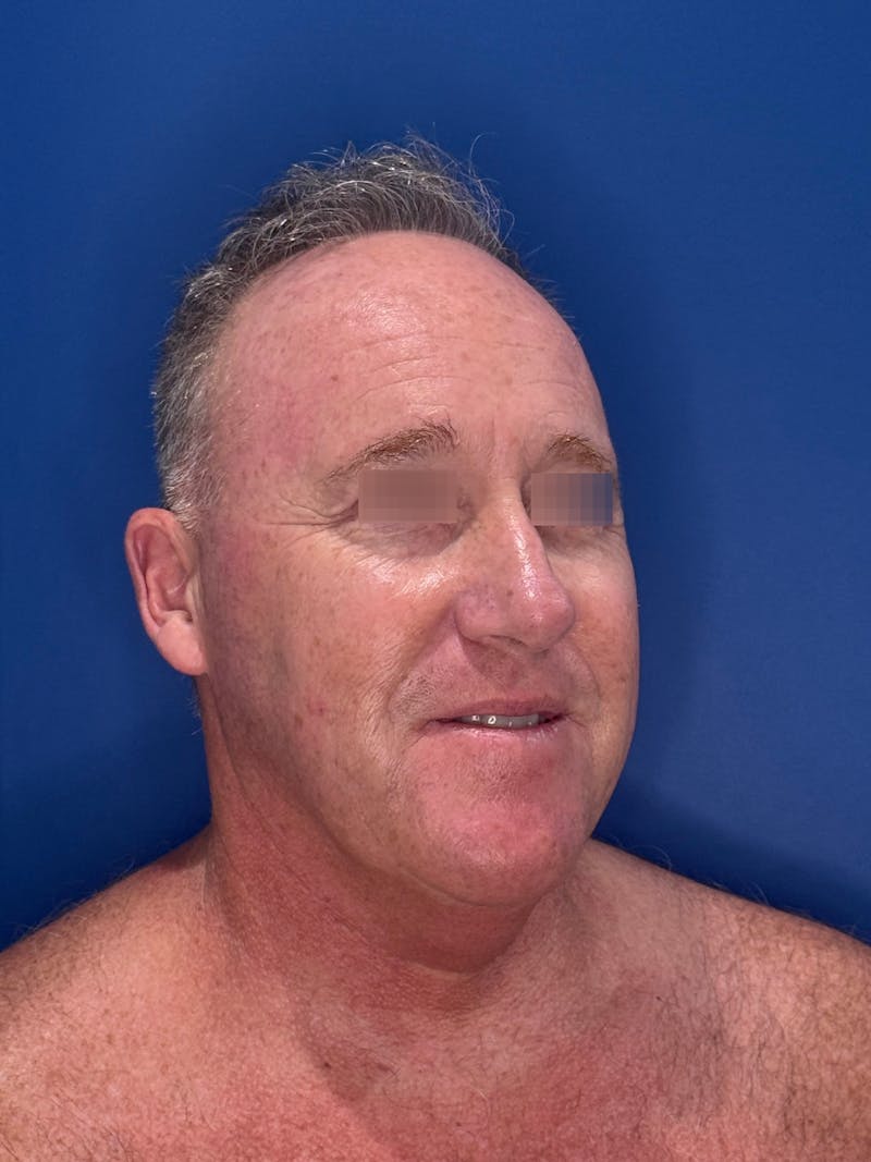 Face Lift Before & After Gallery - Patient 167892 - Image 1