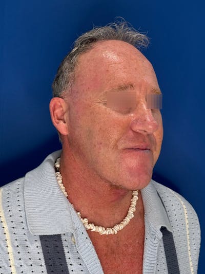 Face Lift Before & After Gallery - Patient 167892 - Image 2