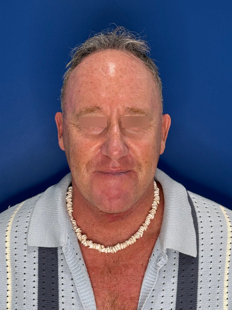 Face Lift Before & After Gallery - Patient 167892 - Image 6