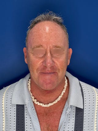 Face Lift Before & After Gallery - Patient 167892 - Image 6