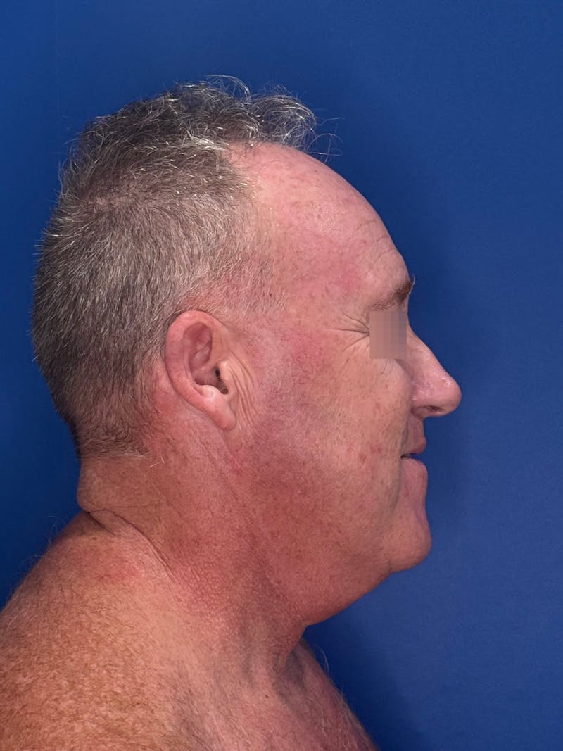 Face Lift Before & After Gallery - Patient 167892 - Image 7