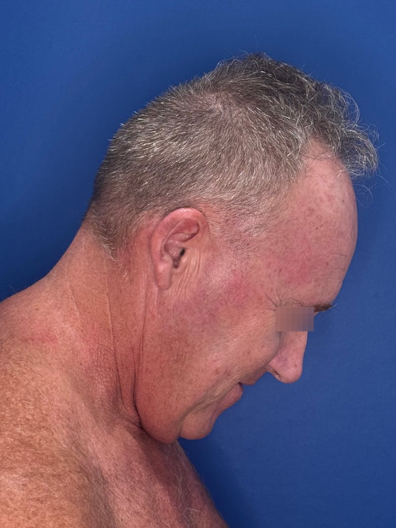 Face Lift Before & After Gallery - Patient 167892 - Image 9