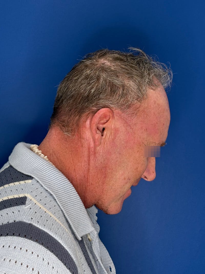 Face Lift Before & After Gallery - Patient 167892 - Image 10