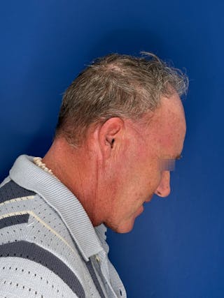 Face Lift Before & After Gallery - Patient 167892 - Image 10