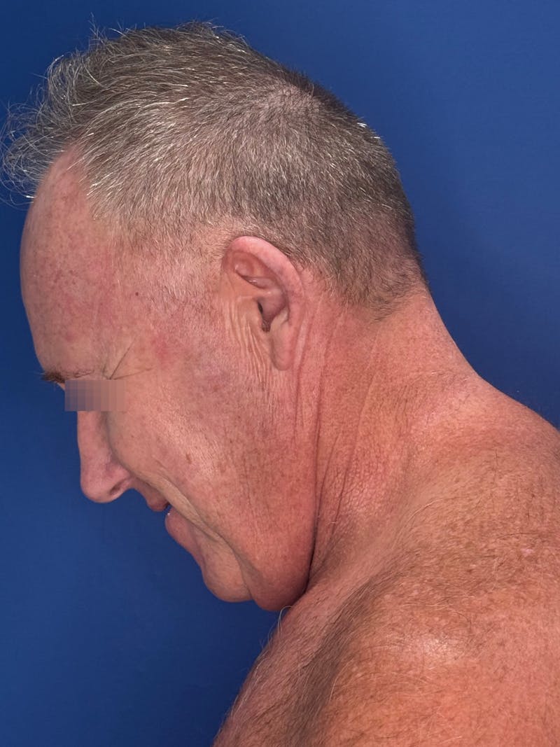 Face Lift Before & After Gallery - Patient 167892 - Image 11