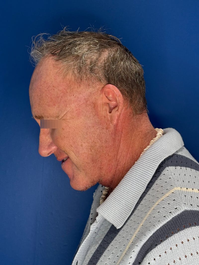 Face Lift Before & After Gallery - Patient 167892 - Image 12