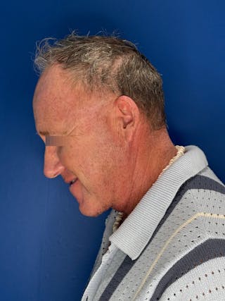 Face Lift Before & After Gallery - Patient 167892 - Image 12