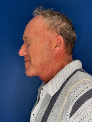 Face Lift Before & After Gallery - Patient 167892 - Image 14